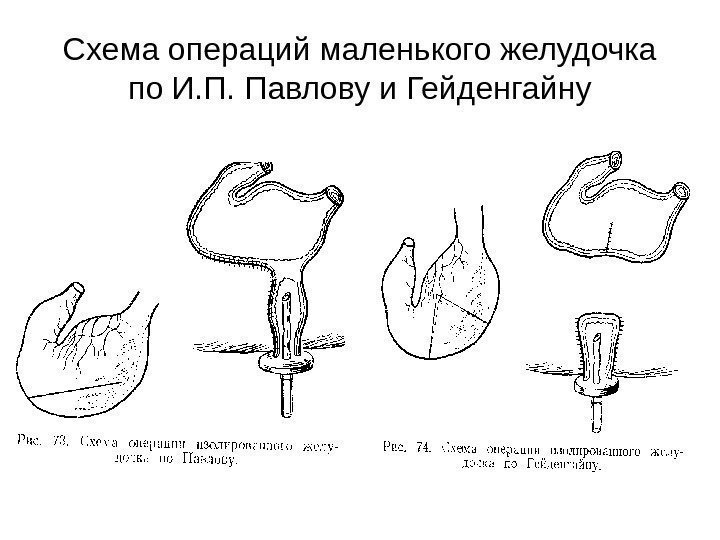   Схема операций маленького желудочка по И. П. Павлову и Гейденгайну 