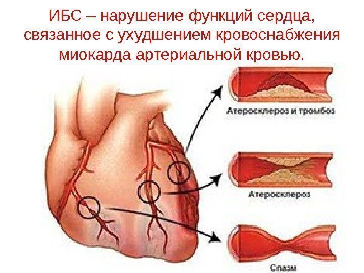 ИБС – нарушение функций сердца,  связанное с ухудшением кровоснабжения миокарда артериальной кровью. 