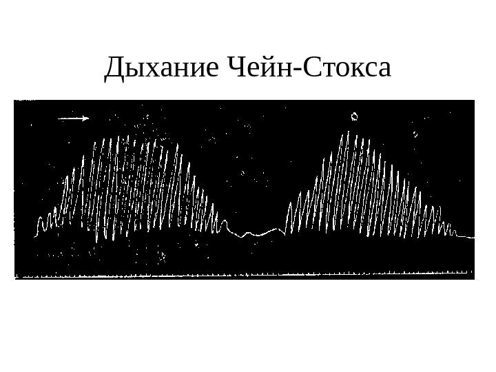   Дыхание Чейн-Стокса 