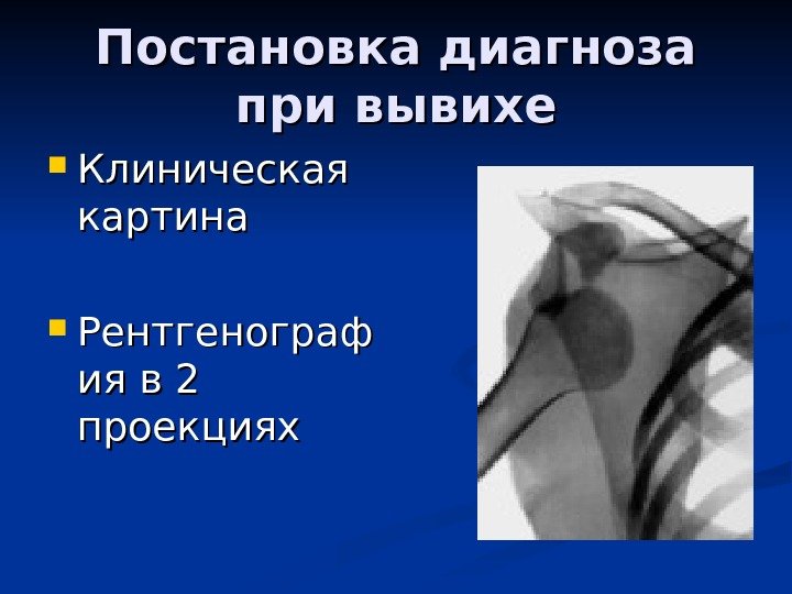   Постановка диагноза при вывихе Клиническая картина Рентгенограф ия в 2 проекциях 