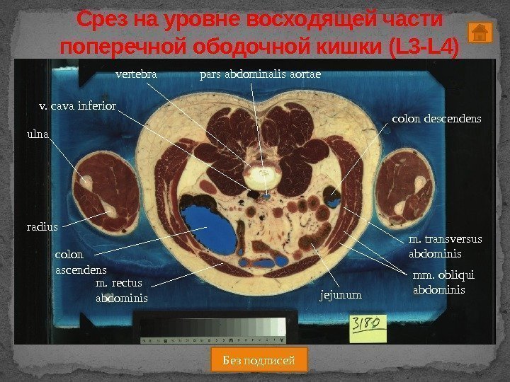 Срез на уровне восходящей части поперечной ободочной кишки (L 3 -L 4) pars abdominalis