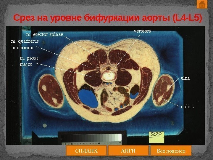 Срез на уровне бифуркации аорты (L 4 -L 5) АНГИСПЛАНХ Все подписиm. erector spinae