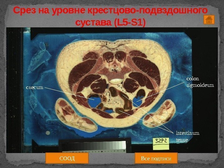 Срез на уровне крестцово-подвздошного сустава (L 5 -S 1) СООД Все подписиcaecum colon sigmoideum