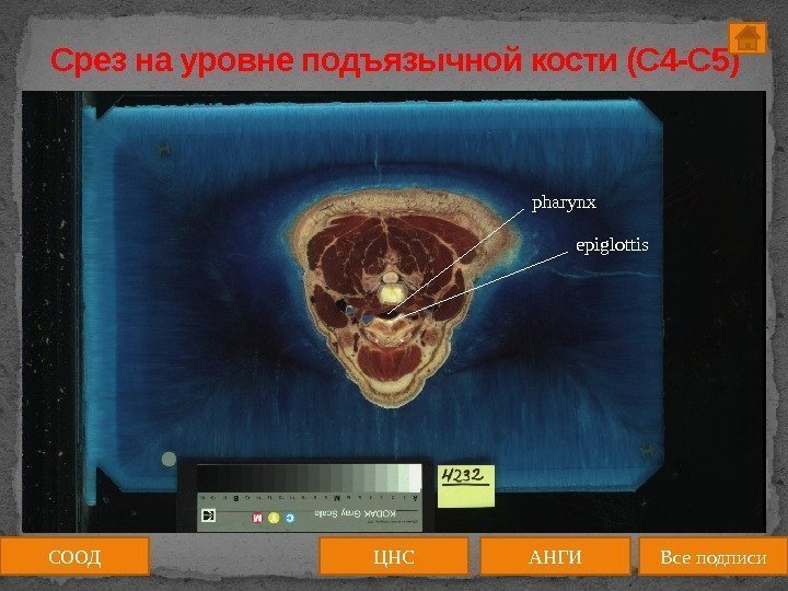Срез на уровне подъязычной кости (C 4 -C 5) medulla spinalis СООД ЦНС АНГИ