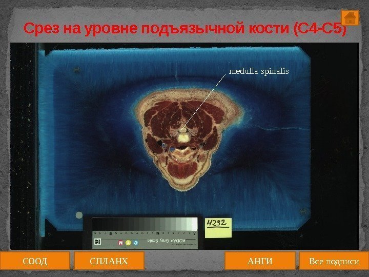 Срез на уровне подъязычной кости (C 4 -C 5) medulla spinalis СООД АНГИСПЛАНХ Все