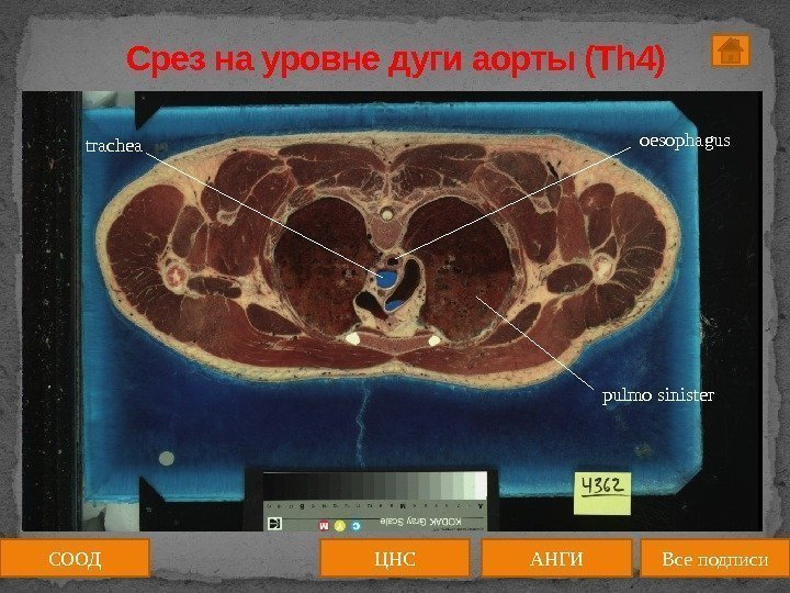 Срез на уровне дуги аорты (Th 4) oesophagus trachea pulmo sinister СООД ЦНС АНГИ