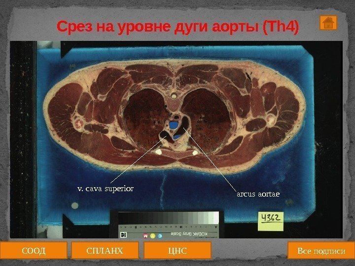 Срез на уровне дуги аорты (Th 4) arcus aortaev. cava superior СООД ЦНССПЛАНХ Все
