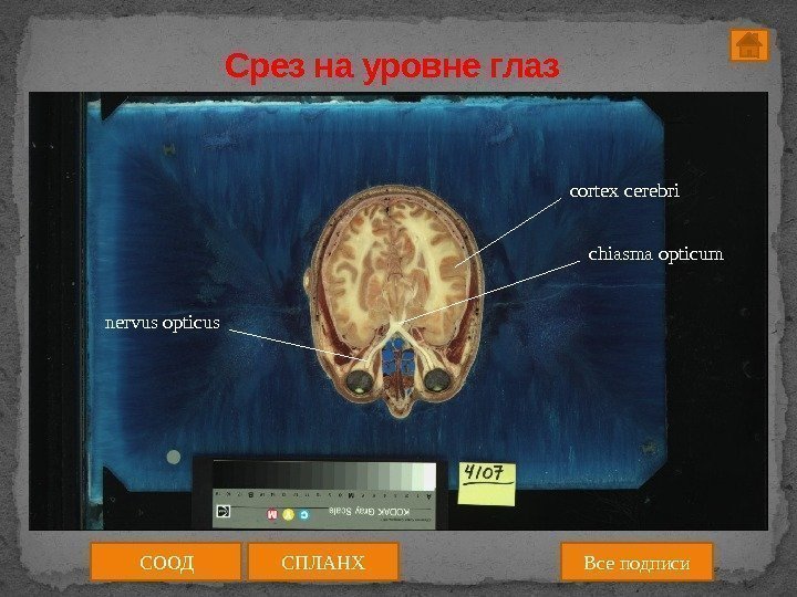 Срез на уровне глаз chiasma opticum nervus opticus cortex cerebri СООД Все подписи. СПЛАНХ