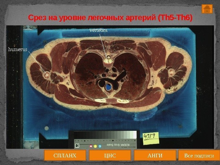 Срез на уровне легочных артерий (Th 5 -Th 6) ЦНС АНГИСПЛАНХ Все подписиhumerus vertebra
