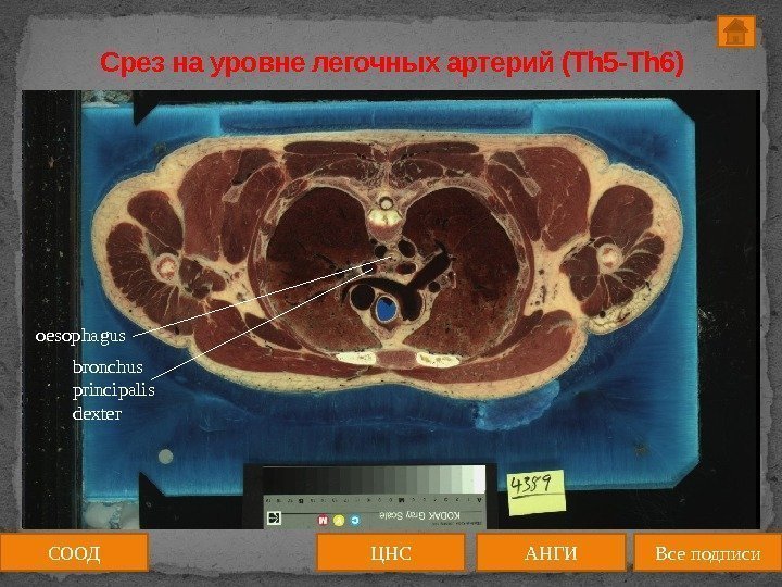 Срез на уровне легочных артерий (Th 5 -Th 6) СООД ЦНС АНГИ Все подписиbronchus