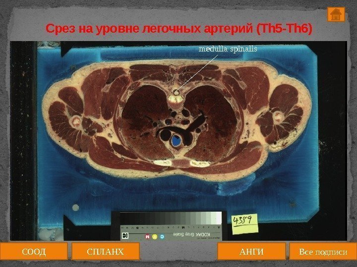 Срез на уровне легочных артерий (Th 5 -Th 6) medulla spinalis СООД АНГИСПЛАНХ Все