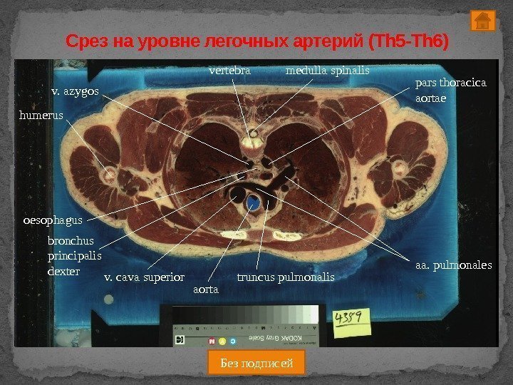 Срез на уровне легочных артерий (Th 5 -Th 6) bronchus principalis dexteroesophagus medulla spinalis