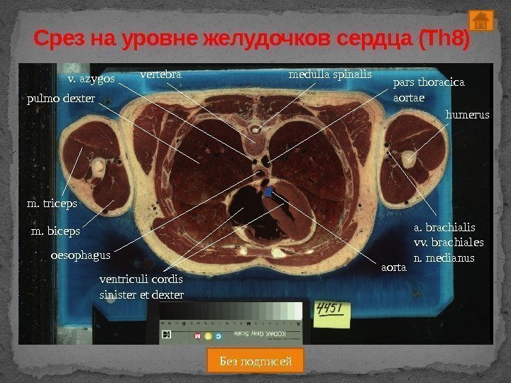 Срез на уровне желудочков сердца (Th 8) humerus ventriculi cordis sinister et dexteroesophaguspulmo dexter