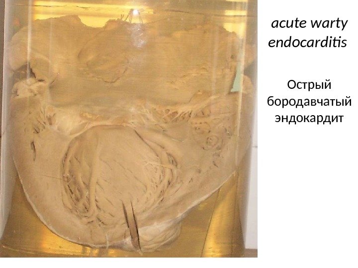 acute warty endocarditis  Острый бородавчатый эндокардит 