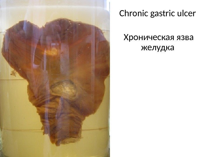 Chronic gastric ulcer Хроническая язва желудка 