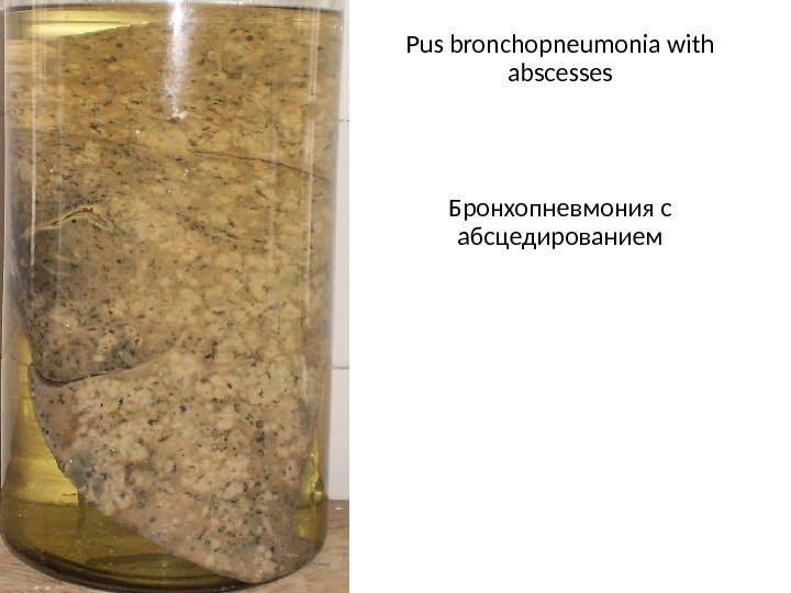 Pus bronchopneumonia with abscesses Бронхопневмония с абсцедированием 