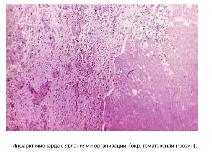 Инфаркт миокарда с явлениями организации. (окр. гематоксилин-эозин).  