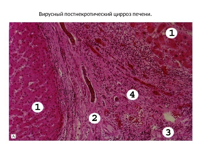 Вирусный постнекротический цирроз печени. 