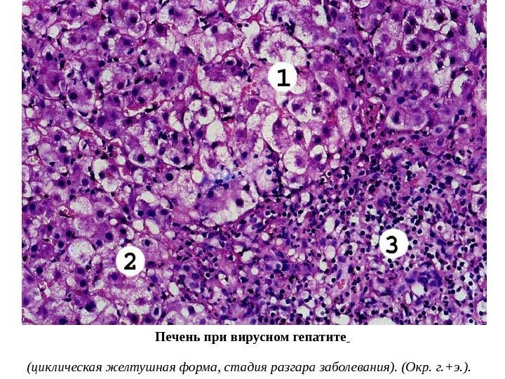 Печень при вирусном гепатите  (циклическая желтушная форма, стадия разгара заболевания). (Окр. г. +э.