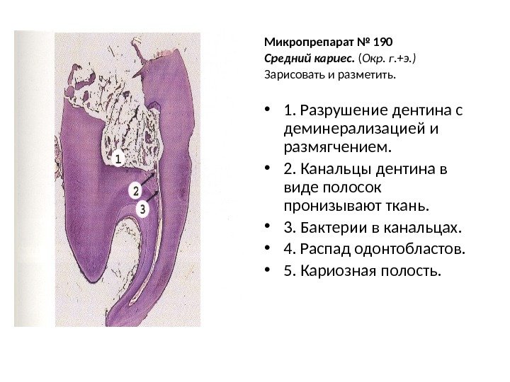 Микропрепарат № 190 Средний кариес.  ( Окр. г. +э. )  Зарисовать и