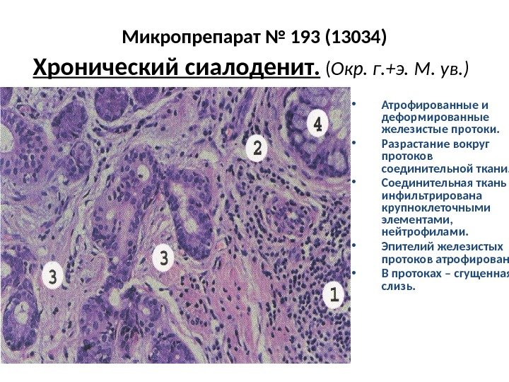 Микропрепарат № 193 (13034) Хронический сиалоденит.  ( Окр. г. +э. М. ув. )