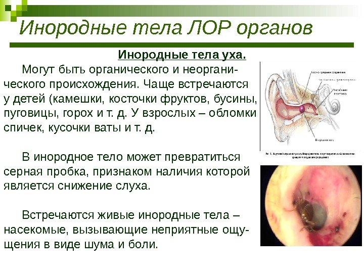 Инородные тела ЛОР органов Инородные тела уха. Могут быть органического и неоргани- ческого происхождения.