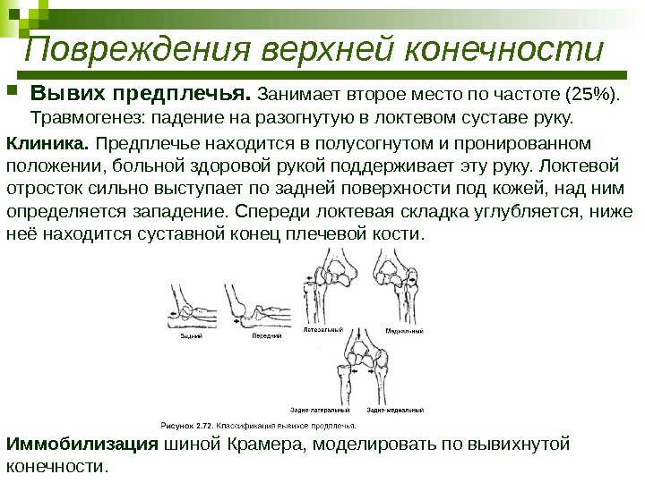  Вывих предплечья.  Занимает второе место по частоте (25).  Травмогенез: падение на