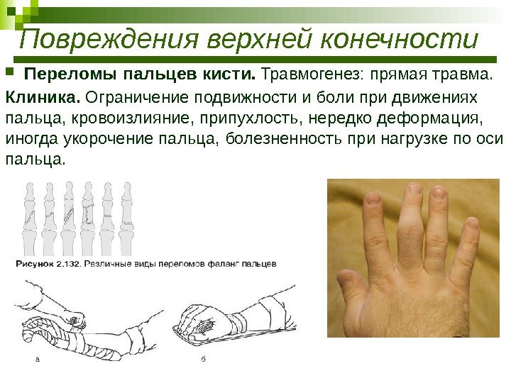  Переломы пальцев кисти.  Травмогенез: прямая травма. Клиника.  Ограничение подвижности и боли