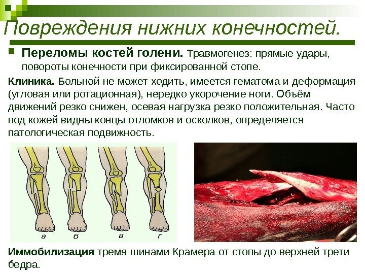  Переломы костей голени.  Травмогенез: прямые удары,  повороты конечности при фиксированной стопе.