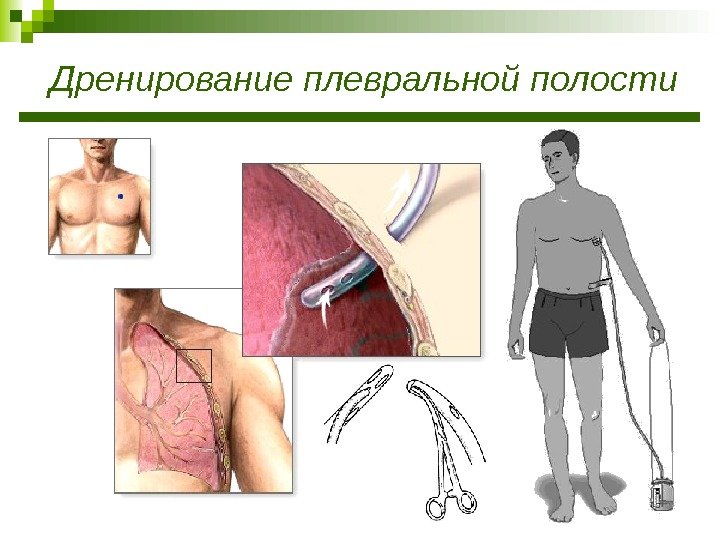 Дренирование плевральной полости 