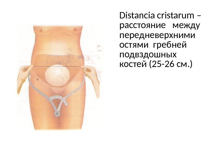 Distancia cristarum – расстояние  между передневерхними  остями гребней подвздошных костей (25 -26