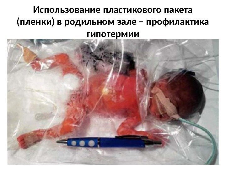 Использование пластикового пакета (пленки) в родильном зале – профилактика гипотермии 