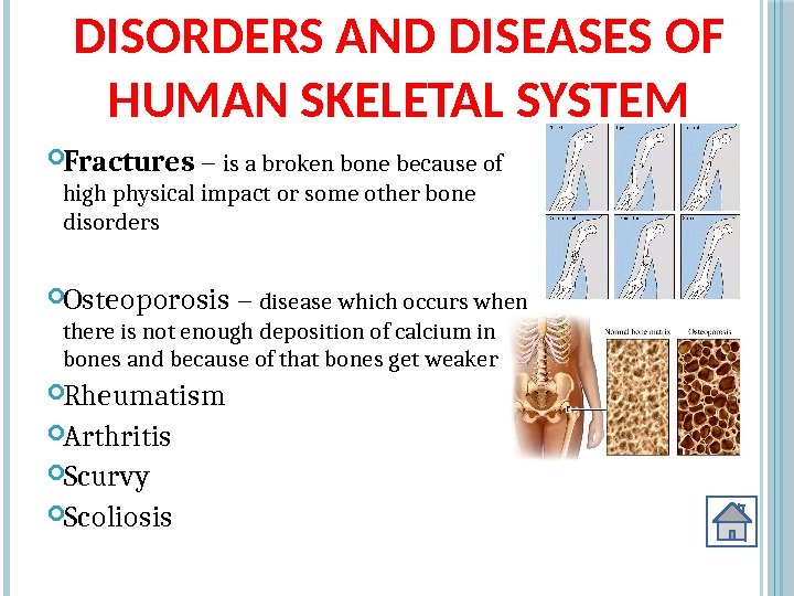 DISORDERS AND DISEASES OF HUMAN SKELETAL SYSTEM Fractures – is a broken bone because
