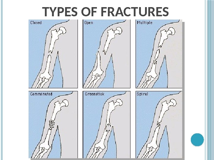 TYPES OF FRACTURES 