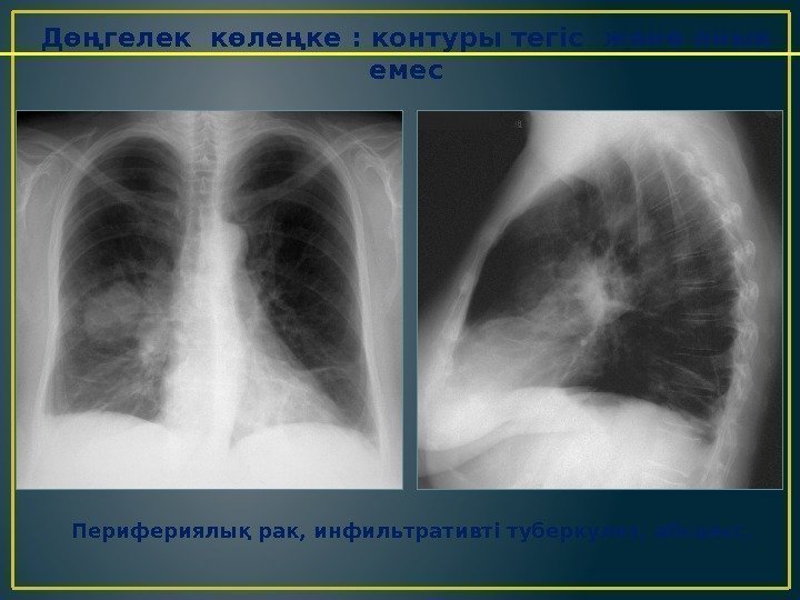 Инфильтративті туберкулез презентация