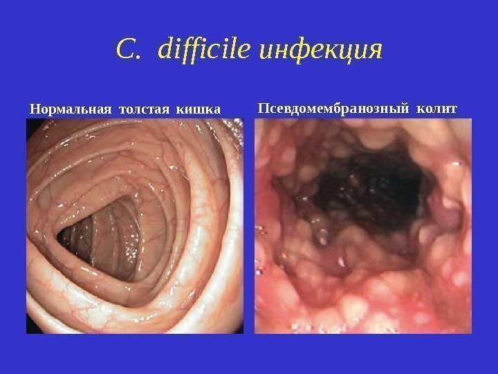 C. difficile инфекция Нормальная толстая кишка Псевдомембранозный колит 