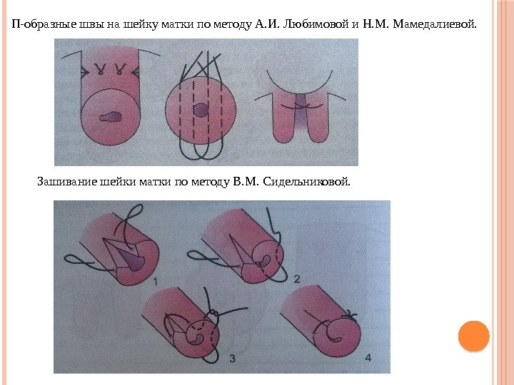 П-образные швы на шейку матки по методу А. И. Любимовой и Н. М. Мамедалиевой.