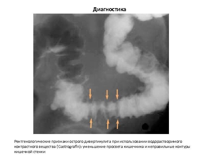 Диагностика Рентгенологические признаки острого дивертикулита при использовании водорастворимого контрастного вещества (Gastrografin): уменьшение просвета кишечника