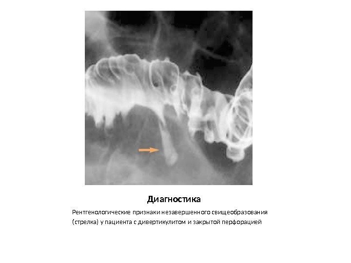 Диагностика Рентгенологические признаки незавершенного свищеобразования (стрелка) у пациента с дивертикулитом и закрытой перфорацией 