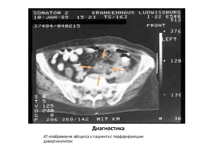 Диагностика КТ-изображение абсцесса у пациента с перфорирующим дивертикулитом 
