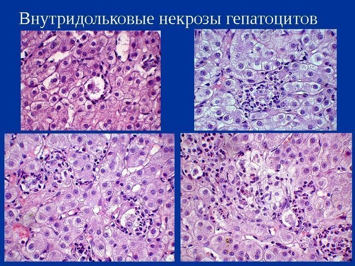 Внутридольковые некрозы гепатоцитов 