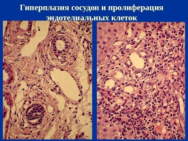 Гиперплазия сосудов и пролиферация эндотелиальных клеток 