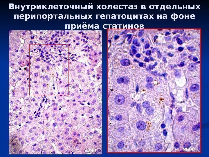Внутриклеточный холестаз в отдельных перипортальных гепатоцитах на фоне приёма статинов х250 х500 