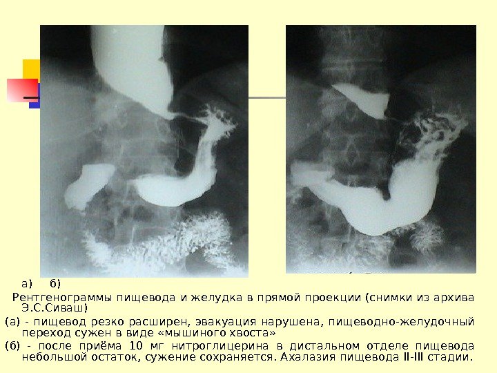 а) б) Рентгенограммы пищевода и желудка в прямой проекции (снимки из архива Э. С.
