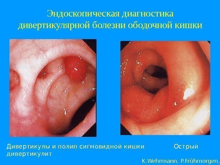 Эндоскопическая диагностика дивертикулярной болезни ободочной кишки Дивертикулы и полип сигмовидной кишки   