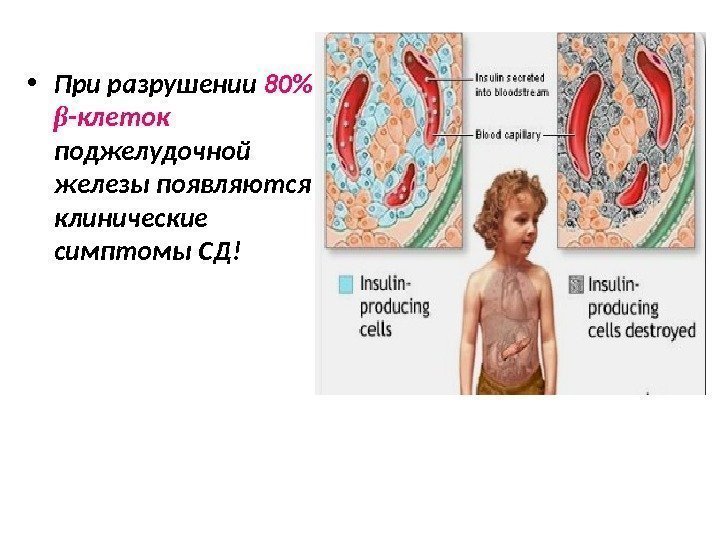  • При разрушении 80 β -клеток  поджелудочной железы появляются клинические симптомы СД!
