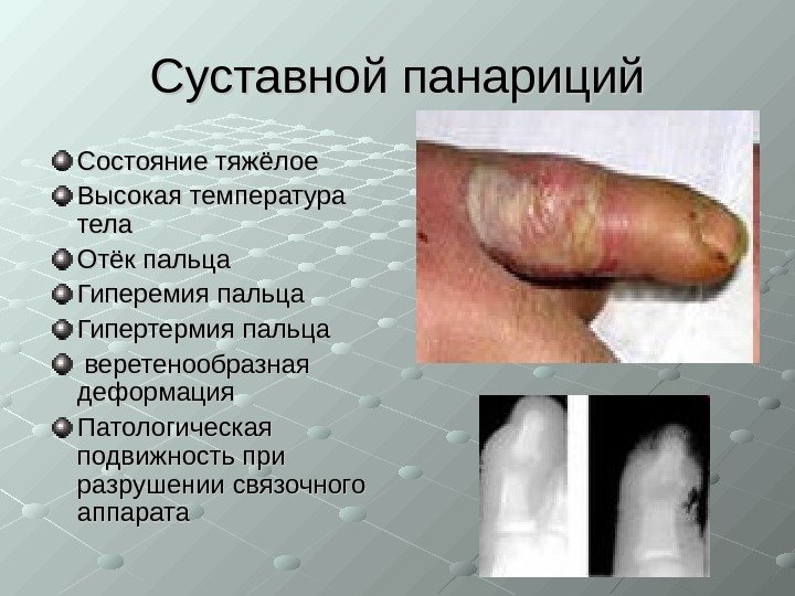   Суставной панариций Состояние тяжёлое Высокая температура тела Отёк пальца Гиперемия пальца Гипертермия
