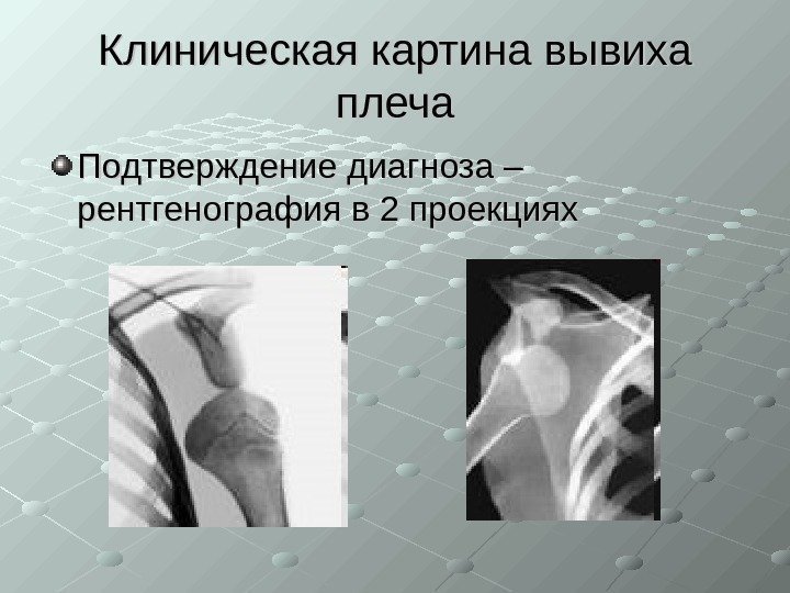   Клиническая картина вывиха плеча Подтверждение диагноза – рентгенография в 2 проекциях 