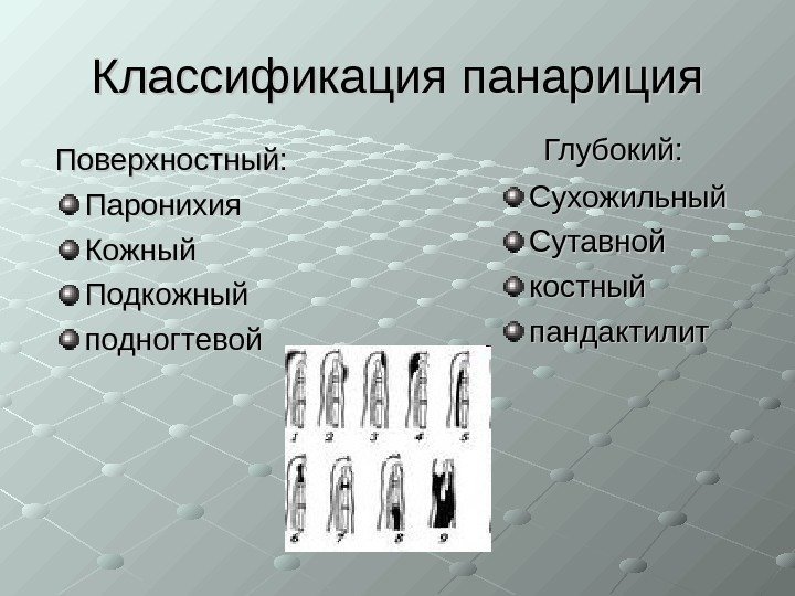   Классификация панариция Поверхностный: Паронихия Кожный Подкожный подногтевой   Глубокий: Сухожильный Сутавной