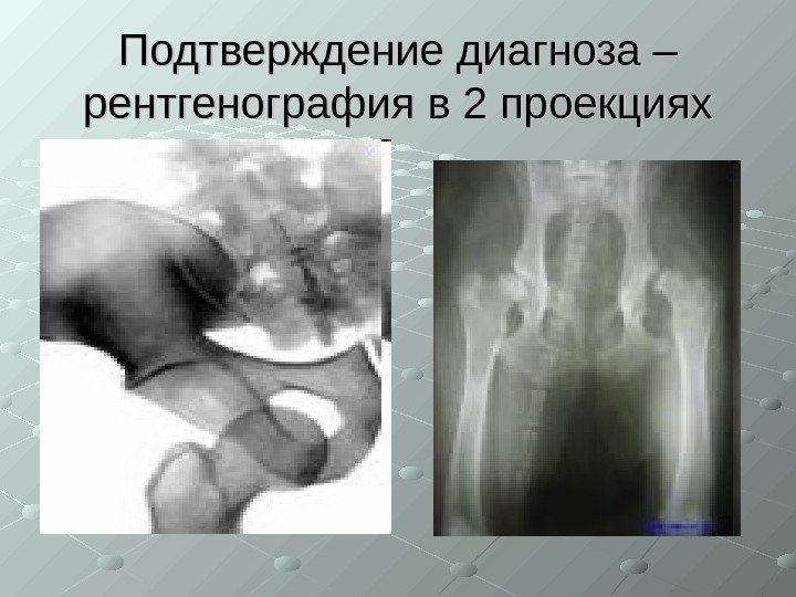   Подтверждение диагноза – рентгенография в 2 проекциях 